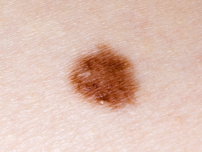 skin-cancer-limassol-cyprus