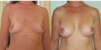 breast implants cyprus