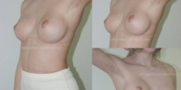 Breast augmentation - no scars operations