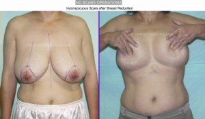 breast reduction limassol
