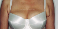 ectopic breast gland limassol