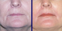 smoothing wrinkles aging lip