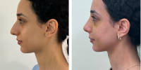 plastic-surgeon-nose-limassol-rhinoplasty